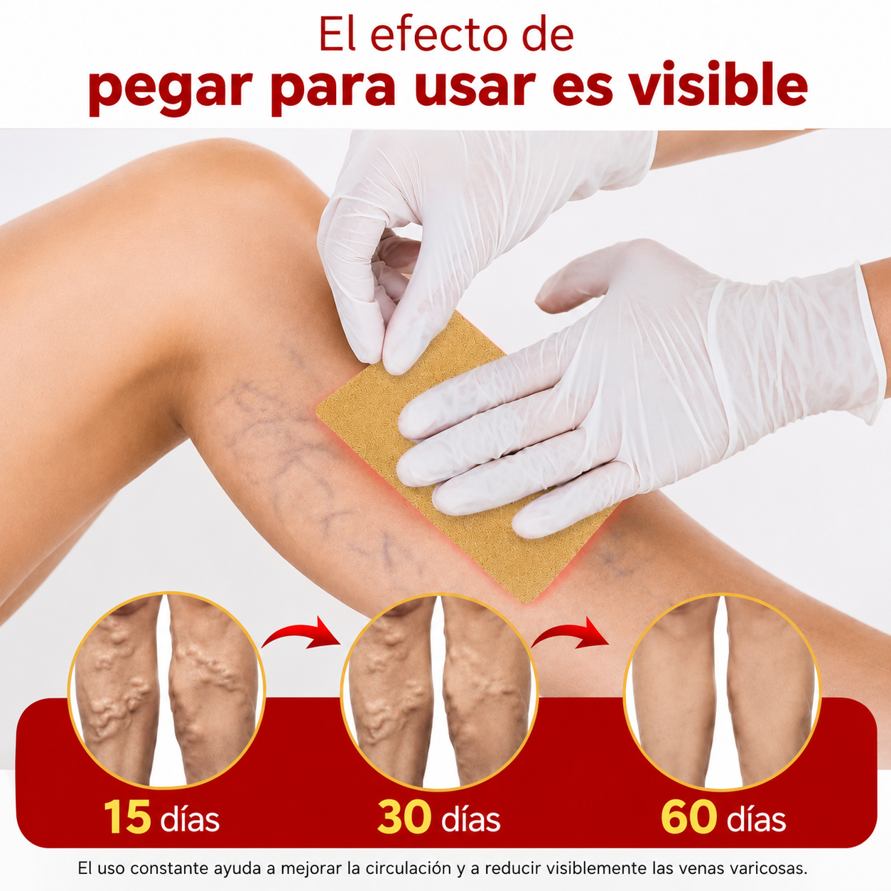Varinex® | Tratamiento de Varices | ¡PRECIO ESPECIAL 50% OFF!
