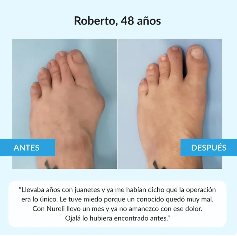 Juanex® | Corrector de Juanetes | ¡PRECIO ESPECIAL 50% OFF!