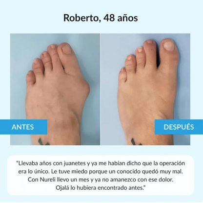 Juanex® | Corrector de Juanetes | ¡PRECIO ESPECIAL 50% OFF!