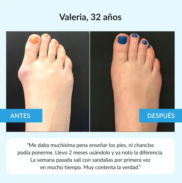 Juanex® | Corrector de Juanetes | ¡PRECIO ESPECIAL 50% OFF!