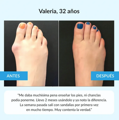 Juanex® | Corrector de Juanetes | ¡PRECIO ESPECIAL 50% OFF!