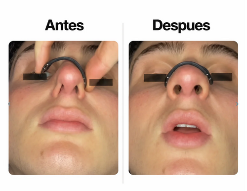 AERIUM PRO® | Dilatador Nasal Magnético Premium | ¡OFERTA EXCLUSIVA DE HOY!