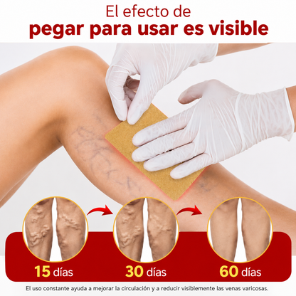 Varinex® | Tratamiento de Varices | ¡PRECIO ESPECIAL 50% OFF!