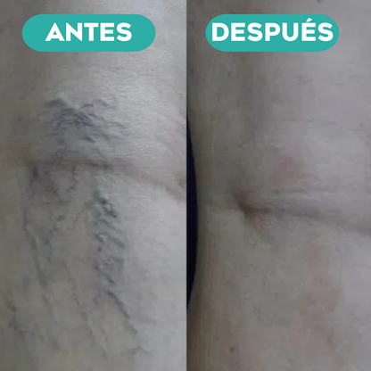 Varinex® | Tratamiento de Varices | ¡PRECIO ESPECIAL 50% OFF!