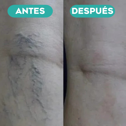 Varinex® | Tratamiento de Varices | ¡PRECIO ESPECIAL 50% OFF!