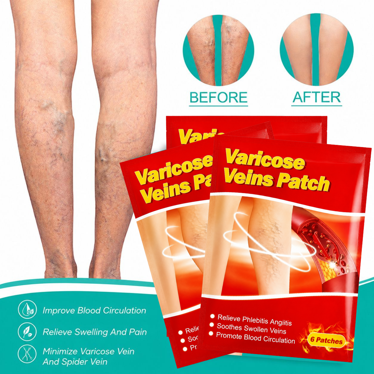 Varinex® | Tratamiento de Varices | ¡PRECIO ESPECIAL 50% OFF!